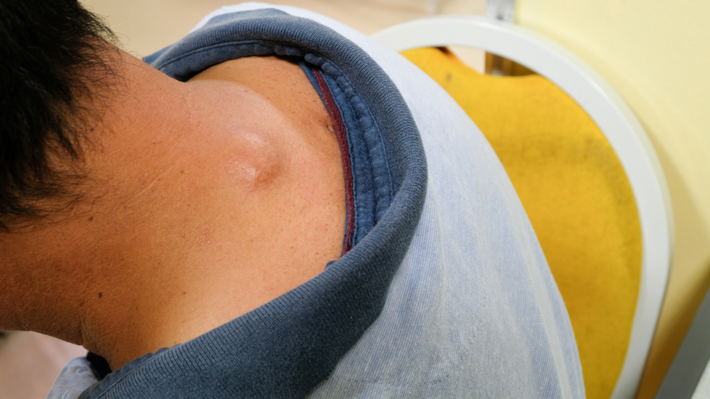 后脑勺发根处疙瘩是癌,后脑勺硬块怎么判断是不是肿瘤