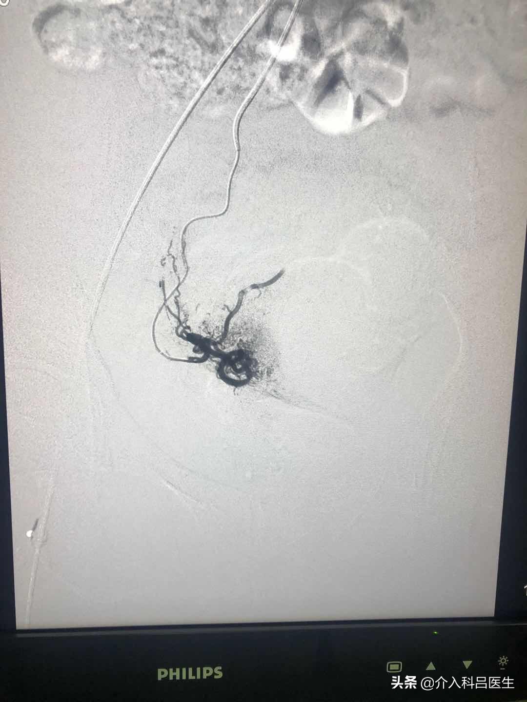 一根针治疗卵巢囊肿手术石家庄,一根针无痛消融子宫肌瘤