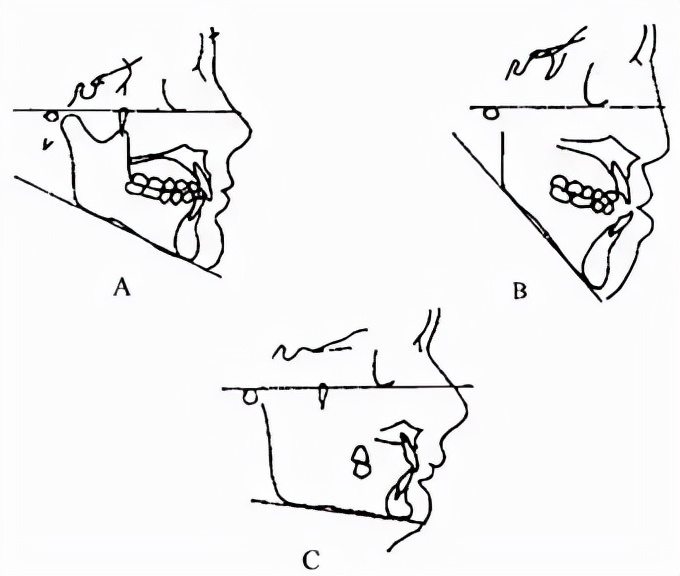 高角型下颌后缩什么样子,高下颌角后缩怎么矫治