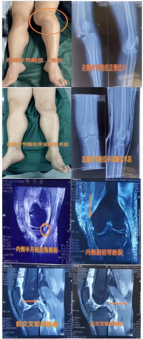 沈阳市骨科医院运动医学科,运动医学科髌骨脱位手术