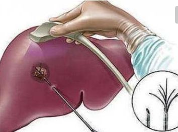 吃药可以消除肝囊肿吗,医生教你治好肝囊肿