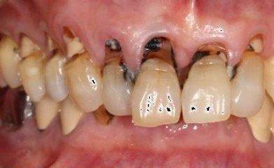 长期横向刷牙当心楔状缺损,横着刷牙一定会出现楔状缺损吗