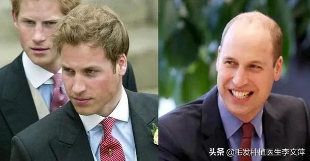 遗传性脱发的症状,遗传性脱发的原因