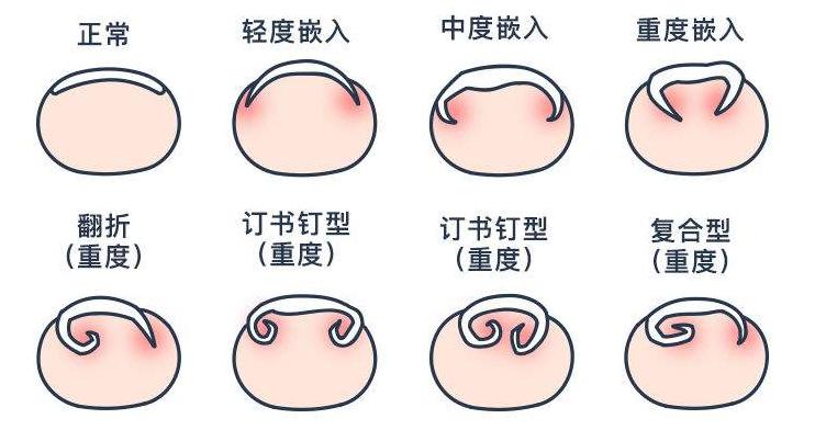脚趾甲总往肉里长怎么矫正,嵌甲旁边的肉怎么消除