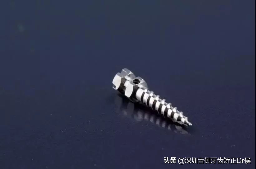 牙齿矫正神器价格,牙齿矫正支撑钉图片