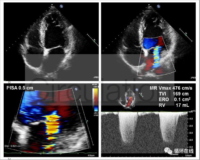沙库巴曲缬沙坦能逆转心脏重构吗,沙库巴曲缬沙坦钠片心悸可以用吗