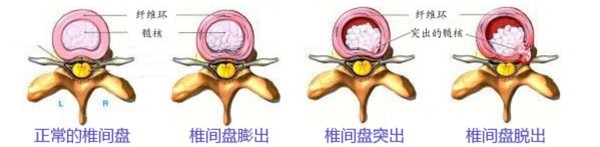 腰间盘突出是肾的原因引起的吗,腰间盘突出究竟是什么