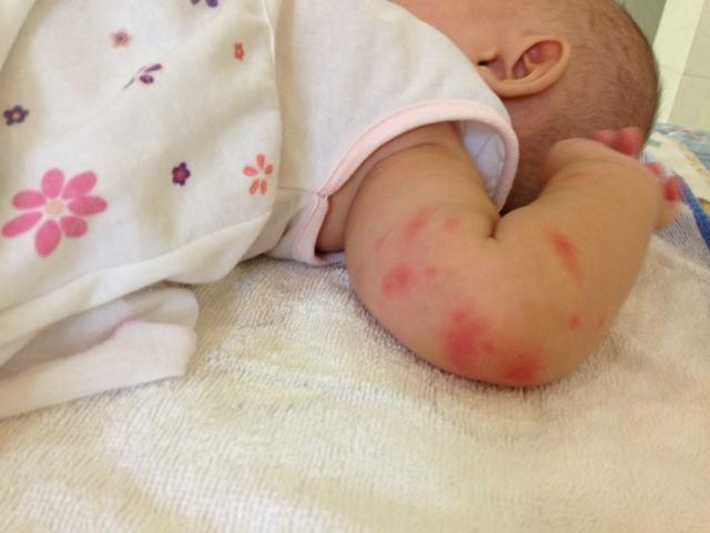 婴儿被蚊虫叮咬反应这么强烈,婴儿反复被蚊虫叮咬有什么危害