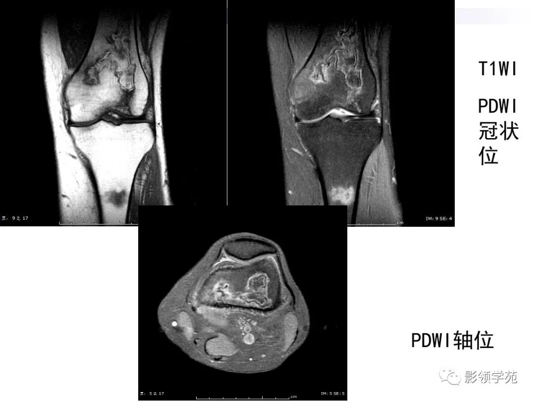 早期骨梗死的ct表现,骨梗死的病理变化