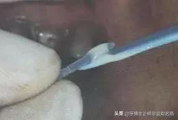 纤维桩修复费用,纤维桩修复全过程视频