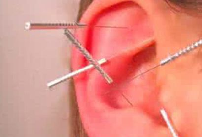 溃疡性结肠炎艾灸几个疗程有效,溃疡性结肠炎能艾灸神阙穴吗