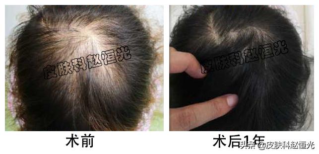 女生头顶头发越来越少了怎么办,头顶头发变细是脱发的前兆吗