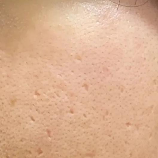 辟谣、吃酱油加深痘印？芦荟胶治好痘坑？别傻了！