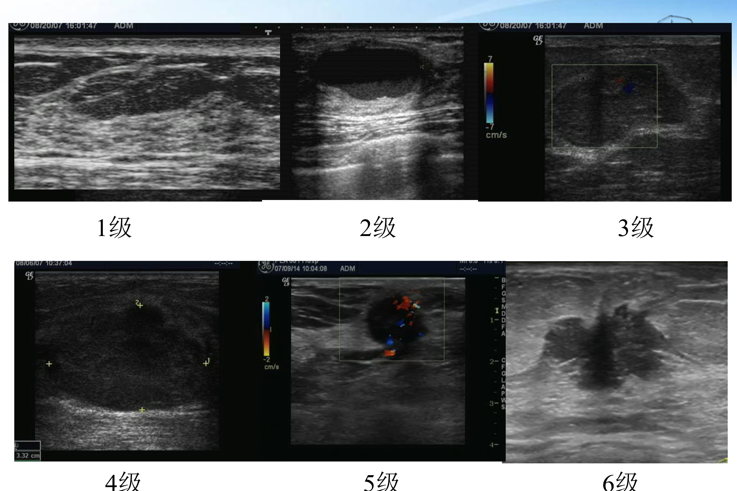 乳腺增生的彩超报告单,教你看懂乳腺钼靶