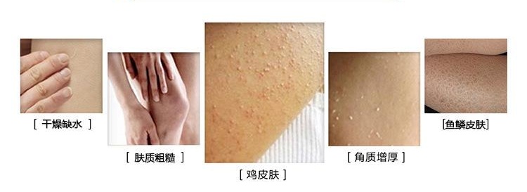 胳膊上突然起了一小片鸡皮疙瘩,胳膊上起了一片红色的像鸡皮疙瘩