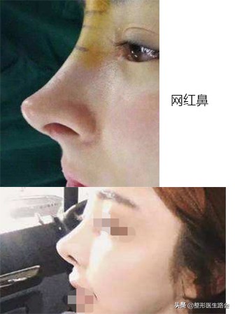 鼻子是怎么垫高的,鼻子垫高点更完美了