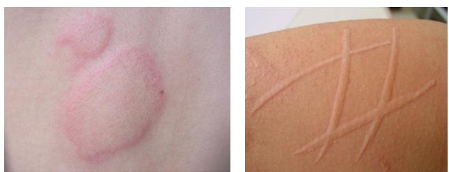 皮肤病蛇缠腰是什么症状,手部常见皮肤病的症状及治疗