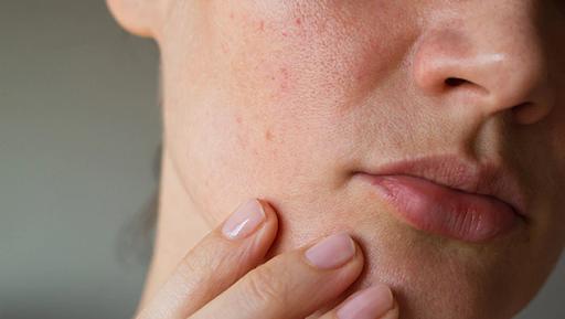 去闭口快速有效的方法,去闭口最有效的方法推荐