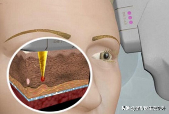 超声刀为什么一个月才能看到效果,超声刀真的会有效果吗