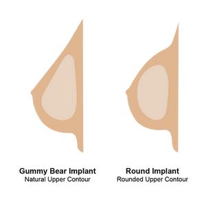 隆胸是现在胸围加上假体厚度吗,假体隆胸术后的胸围会缩一点吗