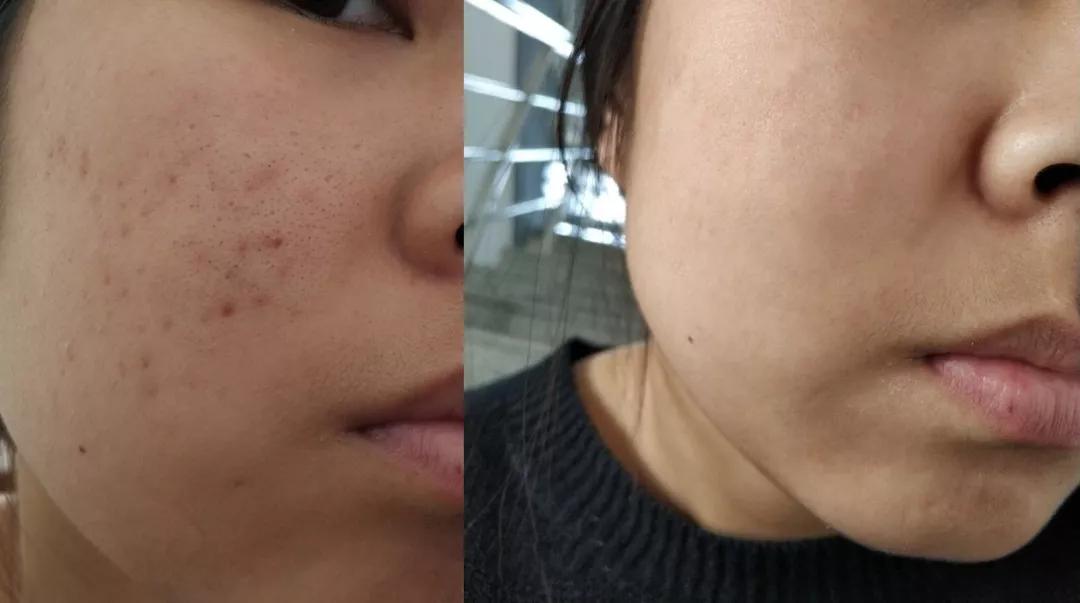 黑头闭口连根拔起,黑头粉刺连根拔起留坑