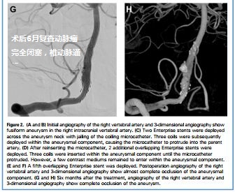 盖延廷大动脉瘤复查,夹层动脉瘤支架治疗