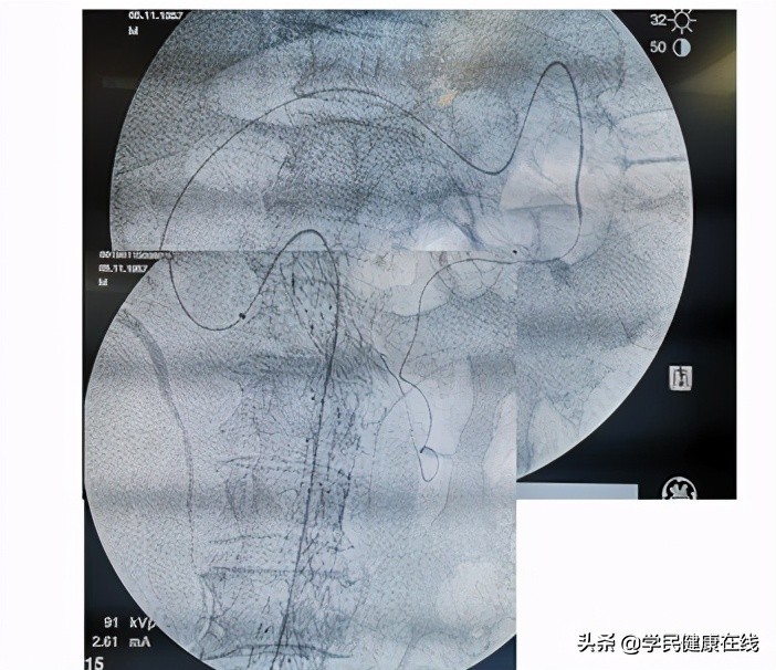 血管外科介入新技术,21世纪血管外科发展方向微创治疗