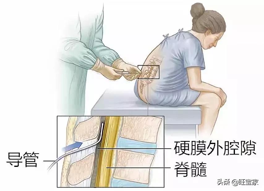 谁说无痛分娩不会痛?当然会痛啦!