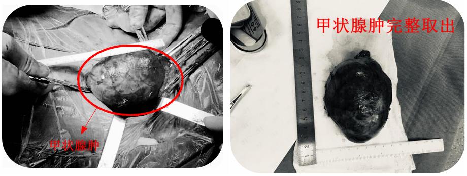 八旬医生抢救老人,老人甲状腺肿大要怎么治疗