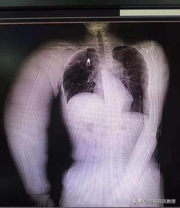 尿毒症手臂造瘘,乳腺癌十年胳膊肿了会有危险吗