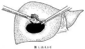 吃药可以消除肝囊肿吗,医生教你治好肝囊肿