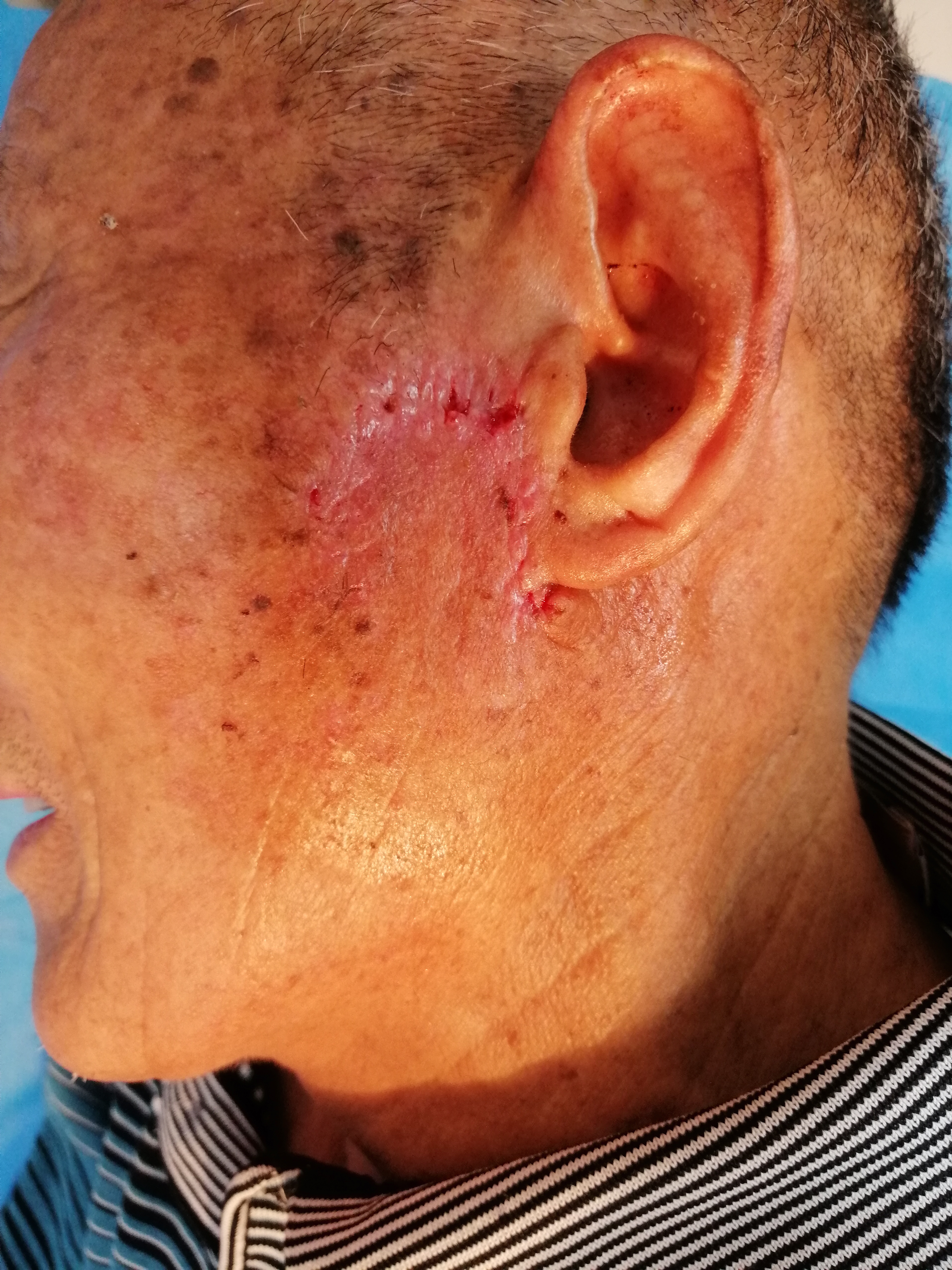 老人脸上出现肉疙瘩,脸上有个硬疙瘩手术切除