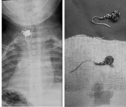 小孩误吞耳环已经到胃里如何处理,儿童误食耳环