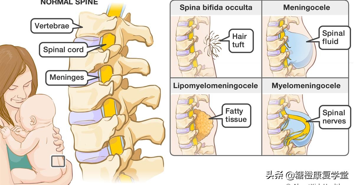 后背脊柱中间凸是正常的吗,脊柱裂腰左侧凸起是怎么回事