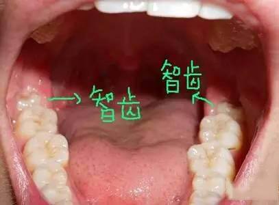 立世牙又叫什么牙,立世牙为什么叫立事牙