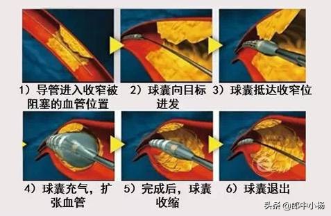 脑血管狭窄中医最好治疗办法,医养结合提升老年人健康能力