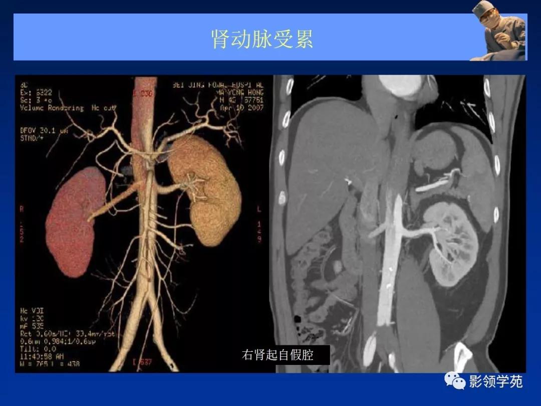 主动脉夹层壁间血肿如何鉴别,主动脉夹层血肿溃疡