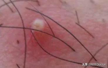 *疮痤**和毛囊炎完全不是一种病，正确区别，不可一概而论