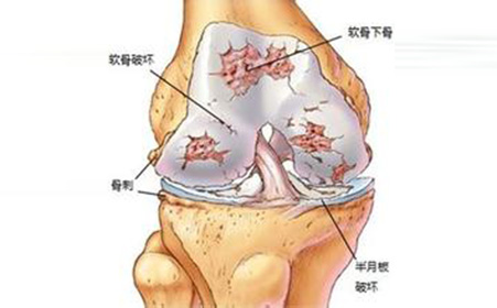 如何预防链球菌感染风湿性关节炎,风湿性关节炎怎么治才能根除