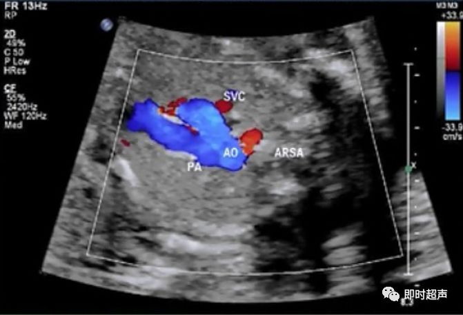 胎儿心脏三种血管关系模式图,25周的胎儿心脏弓切面多少正常