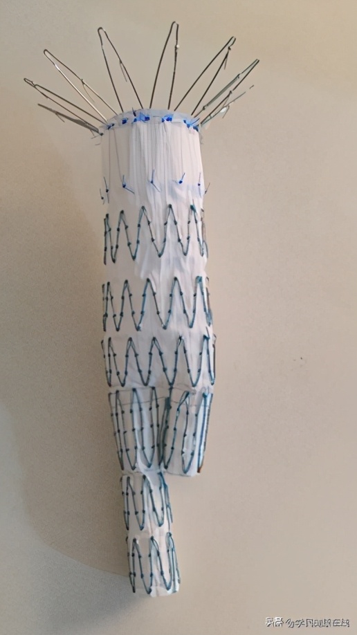 腹主动脉瘤术后内瘘怎么办,腹主动脉瘤出现内瘘解决办法