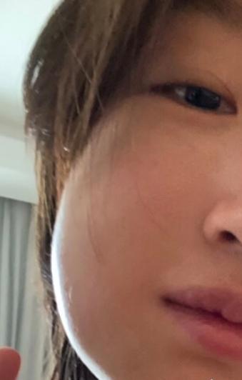 周冬雨拔智齿脸肿成了表情包,周冬雨拔智齿前后脸型对比图