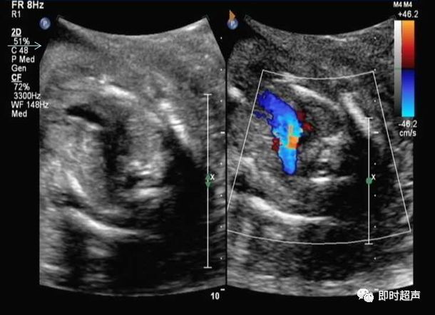 胎儿心脏三种血管关系模式图,25周的胎儿心脏弓切面多少正常