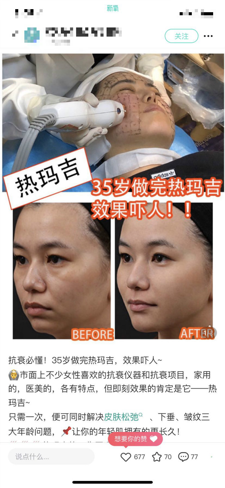 热玛吉官方授权认证医生,假的热玛吉有必要做吗