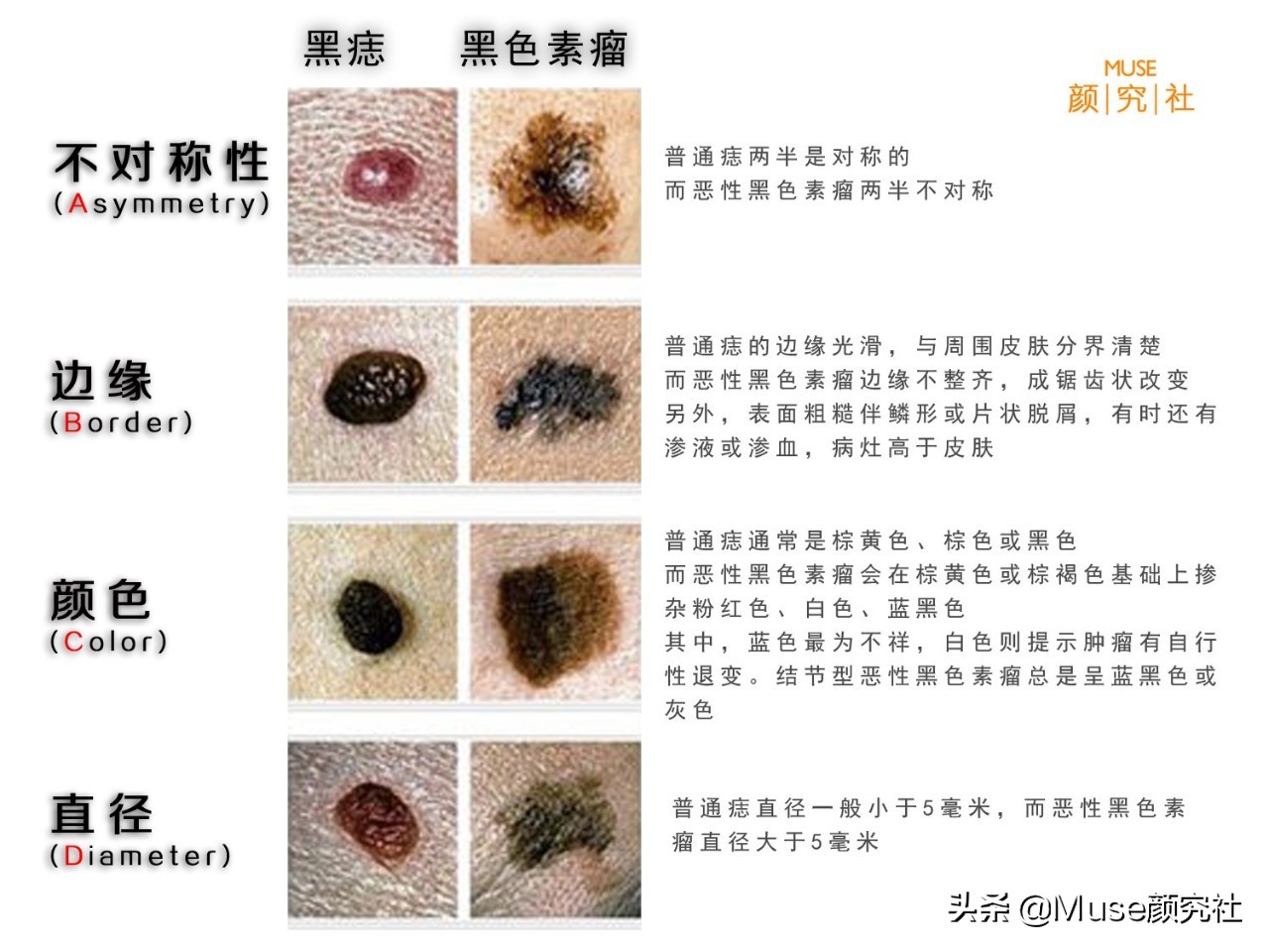 眼下有痣胸上也必定有痣吗,左胸有痣在上右胸有痣在下