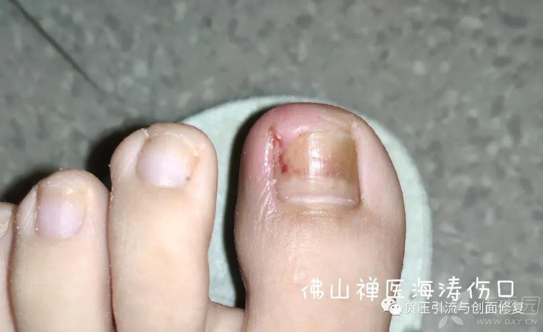 自己剪掉甲沟炎肉芽自己会消掉吗,甲沟炎拔甲后复发的几率多大