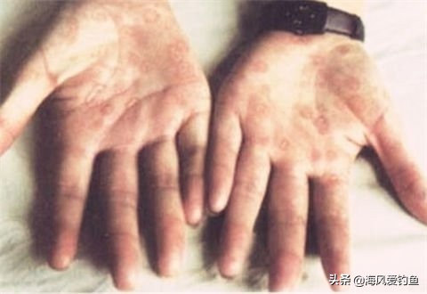 养殖的红虫有毒吗,钓鱼红虫到底有没有毒