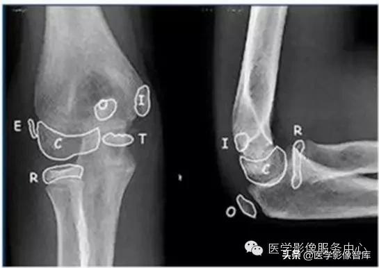 肘关节x线测量,肘关节骨骺示意图