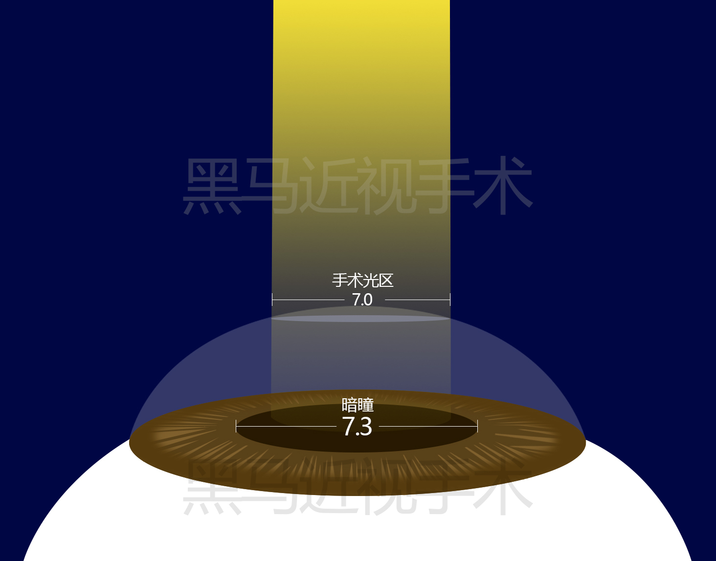激光近视矫正手术有什么后遗症,激光治疗近视安全啊有没有后遗症
