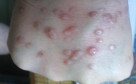 由hpv引起的扁平疣怎么办,扁平疣是hpv怎么治